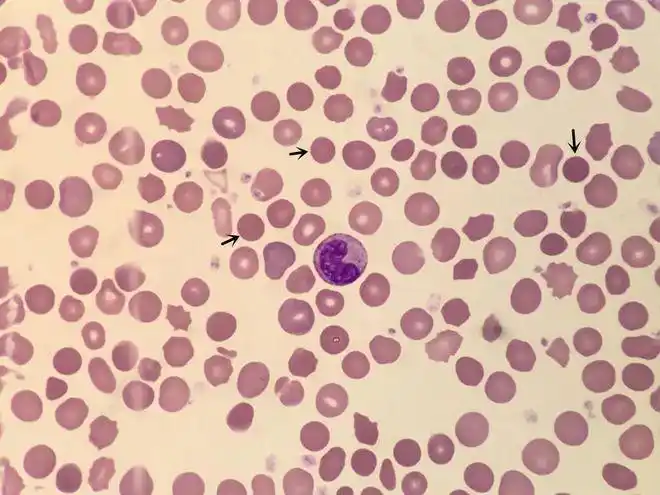 血涂片细胞学检查:成熟红细胞形态大小不一,嗜多色性红细胞易见,见