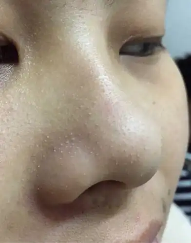 黑头粉刺巨恐怖怎么办?