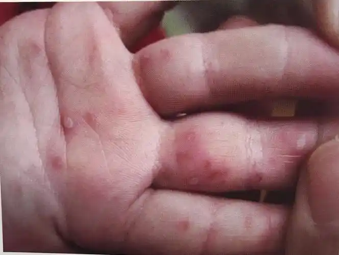 手足口病的症状与预防