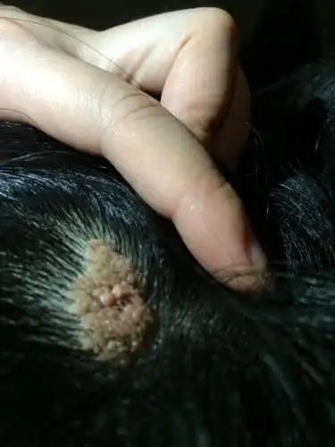 0回答 [【急!】谁知道郑州治疗甲状腺结节专科在几楼? 3回答