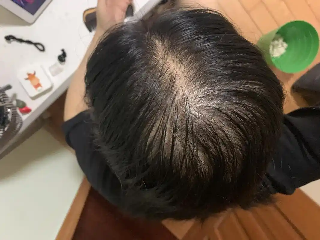 9.25/弥漫性脱发范围逐渐变大!