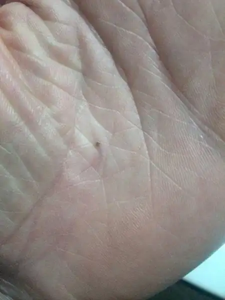 我左手手掌心有一颗痣,他们说手掌心有痣是叫做和合痣.