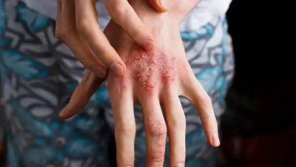 鱼鳞病症状有哪些?儿童期多注意