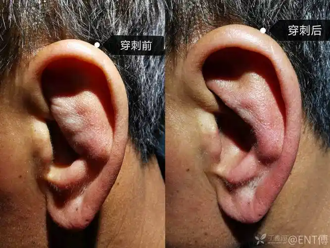 耳廓假性囊肿一例分享