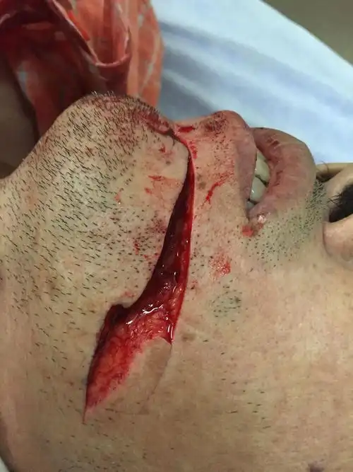 伤情鉴定是在出院以后才能鉴定吗?