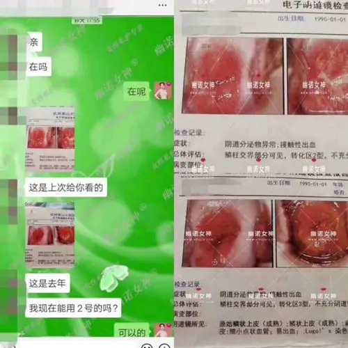 我患有霉 菌性阴 道 炎,调理前豆腐渣白带非常多,长时间使用克霉唑等