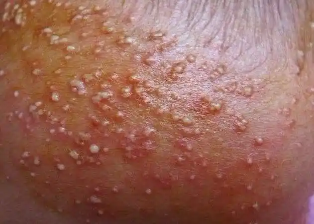 婴儿热痱子症状图片