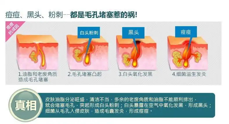挤痘痘好么?脸上的痘痘怎么去除才安全?