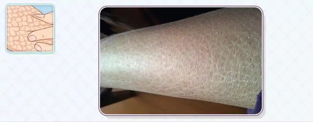 皮肤有鱼鳞纹干燥怎么办皮肤干燥脱皮严重像鱼鳞怎么办