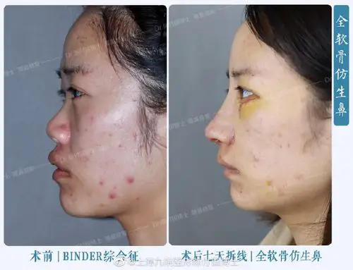 鼻修复案例binder综合症鼻综合修复全软骨术后面中立体