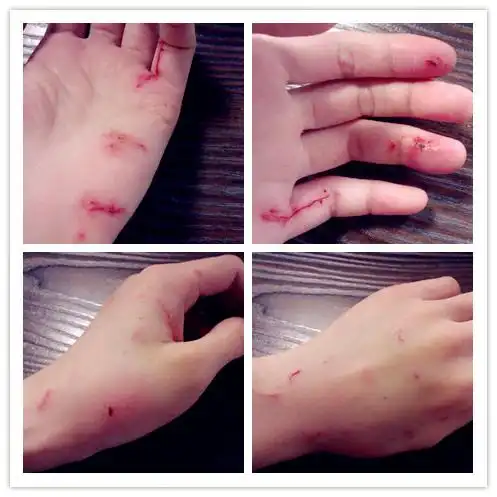 被家养的没出过门的猫咬伤了,四个月前我打过狂犬疫苗,昨晚咬伤后一