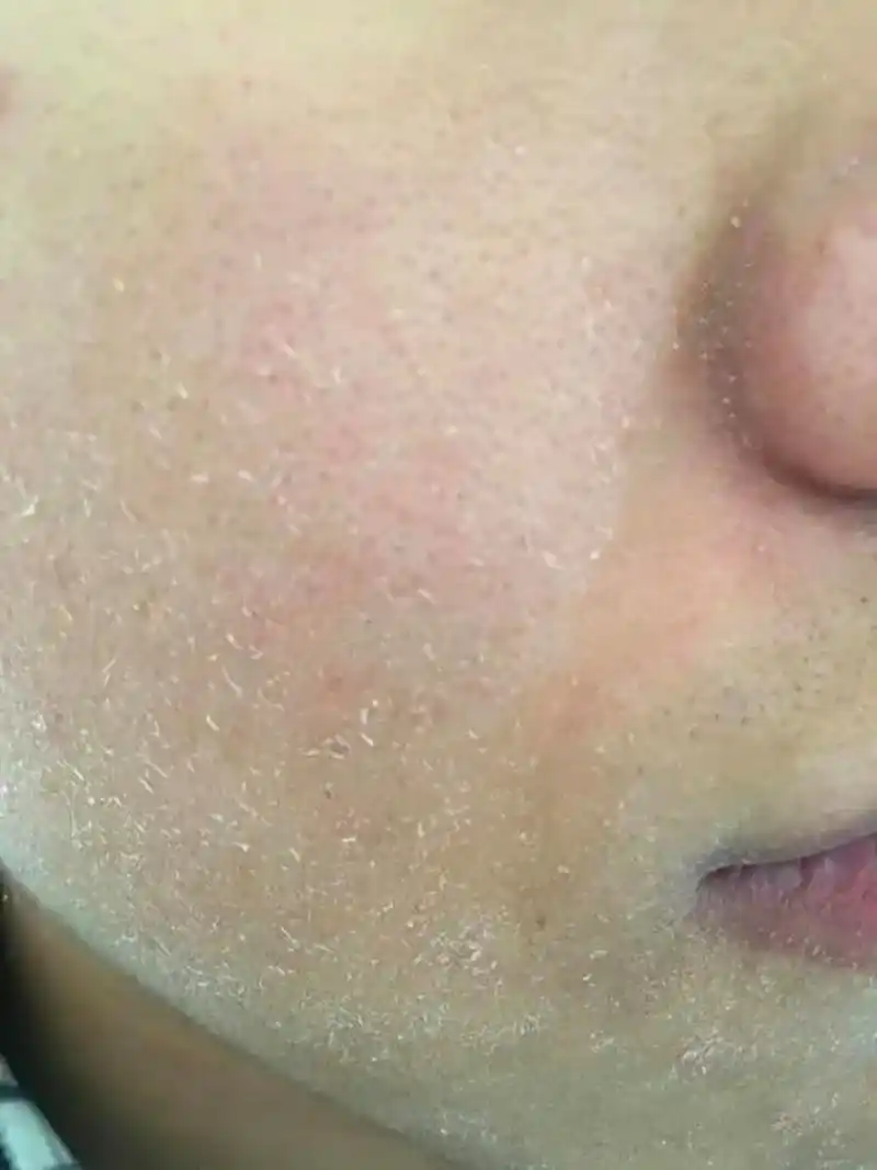 还是面部皮肤粗糙,要解决这个问题需考虑以下几个方面:  定期去角质