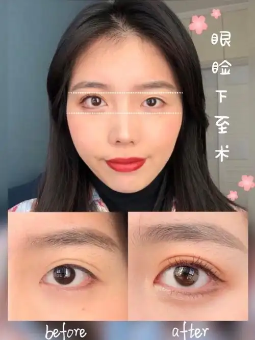 99哈喽啊宝宝们,今天跟宝宝们分享下关于眼睑下至的问_圈子-新氧