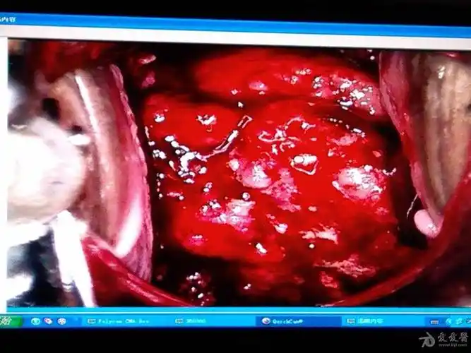 发几张最后确诊为宫颈癌的阴道镜图片