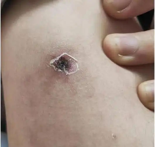 女子郊游回来后高烧不退,手臂上一块结痂的地方揭开"谜底"