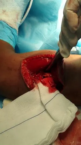 患者男性24岁,高处坠落伤肱骨开放骨折,桡神经完全断裂.