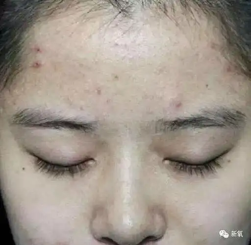 的问题可能更严重,不仅肤色暗黄,还可能有痘印,斑点,加上肤色不均匀