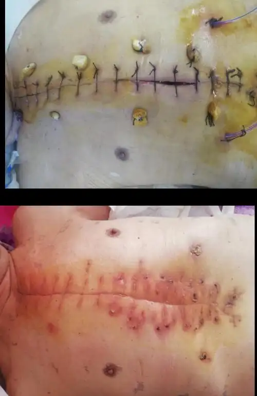 胸骨哆开伴纵隔摆动