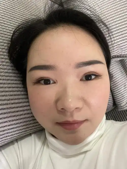 双眼皮马上半年