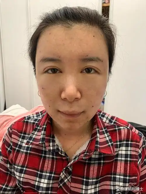 全脸脂肪填充刚做完感觉好丑怎么办?