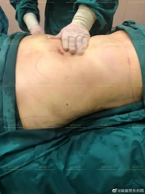 腰腹环吸##黄金微雕