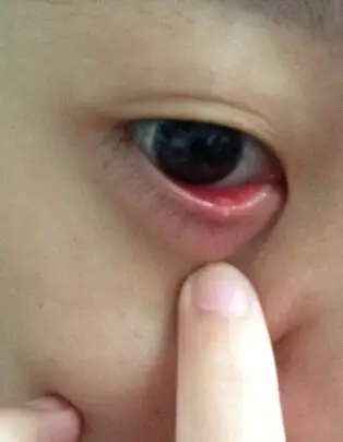 化脓性炎症,西医叫睑腺炎,如果是外睑腺炎,就是我们平常所说的麦粒肿