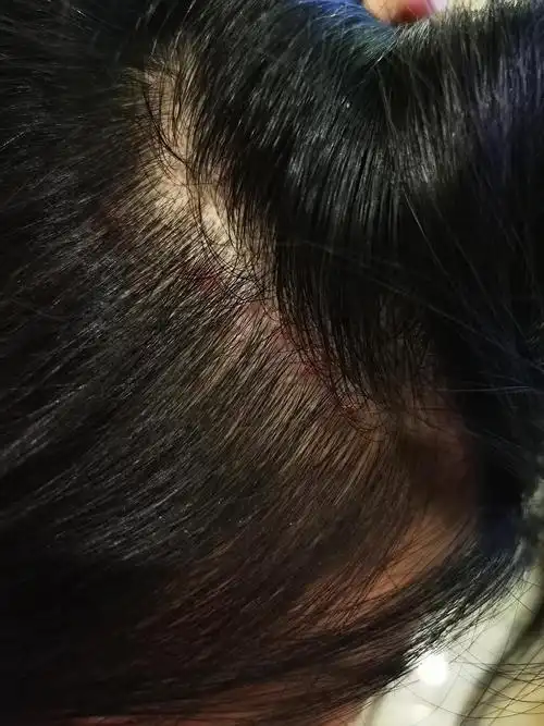 头皮的痘痘到底要怎么治啊?有图慎入