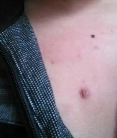 胸口长了个豆豆,怎么回事,大概2年了,好像还长了点,有黑头