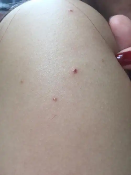 2016-06-13 14:49    浏览  33333  推荐回答 你好,考虑毛囊炎