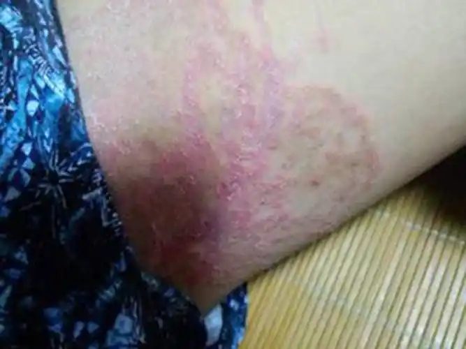 孕妇疥疮初期腹部皮肤症状图片