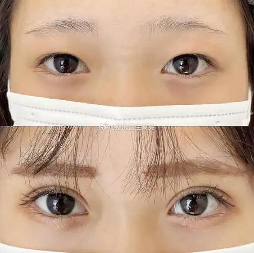 【粉丝反馈】小平行7mm,术后2个月对比,给大家参考#成都双眼皮##高亮