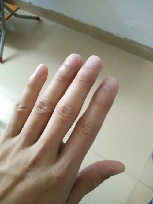 为什么每个手指头都又红又黑的,怎么回事?