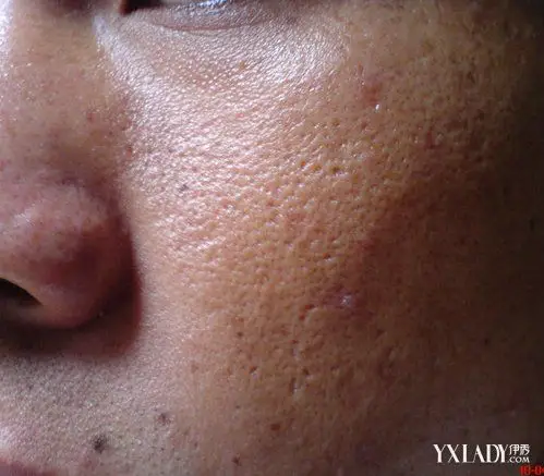 女生脸上皮肤粗糙毛孔大怎么办 分享3个缩毛孔妙招