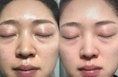 夏天容易油腻毛孔粗试试能量小黑膜让肌肤水润嘭弹超净爽