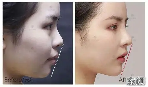 有下巴和没下巴差距有多大?