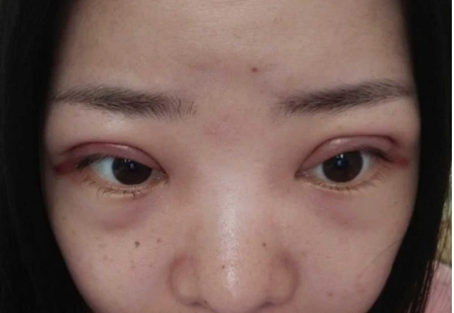 那些割了双眼皮的女生,10年后会变成什么样?医生说出了真相