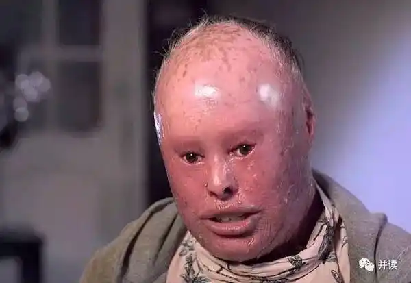 女子患鱼鳞病像蛇一样脱皮,一年掉80斤皮!