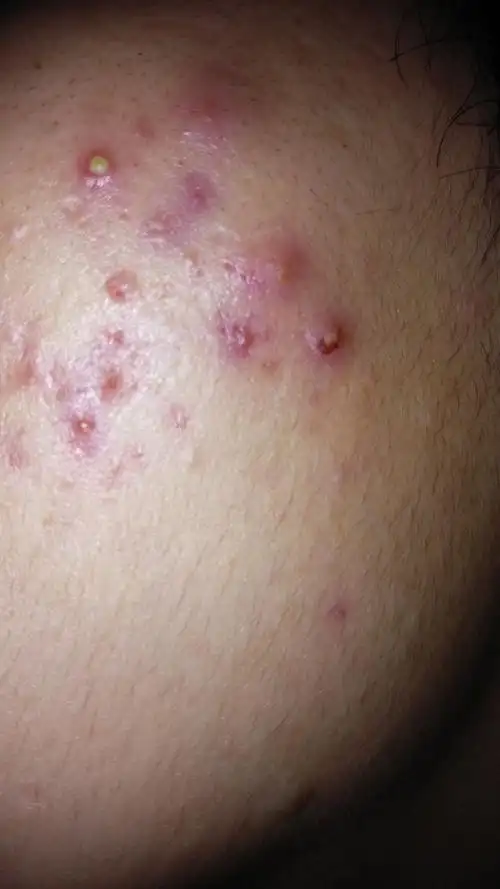 痘痘久久不消怎么办呀?