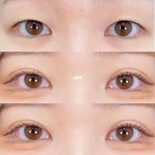 单眼皮双眼皮