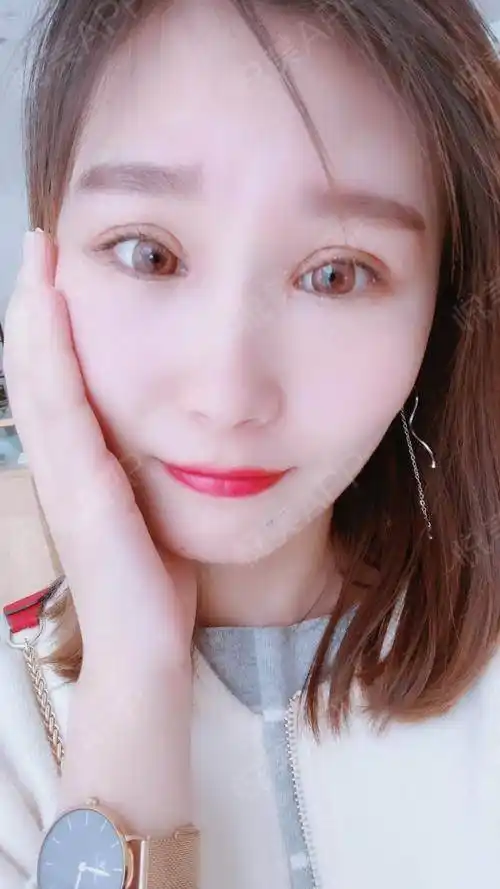 全切双眼皮术后20天_双眼皮术后20天_眼部整形术后20天_小蔡一碟分享