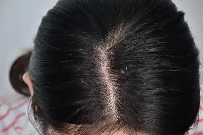 正常的头皮屑图片_有来医生