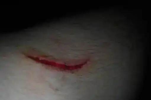 怎么判断伤到真皮层图片