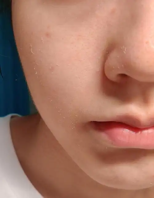 求问!脸部起皮是屏障受损还是需要去角质呀