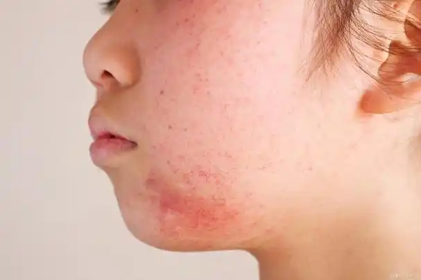 脸上的牛皮癣很烦人,怎样做才能赶跑它?