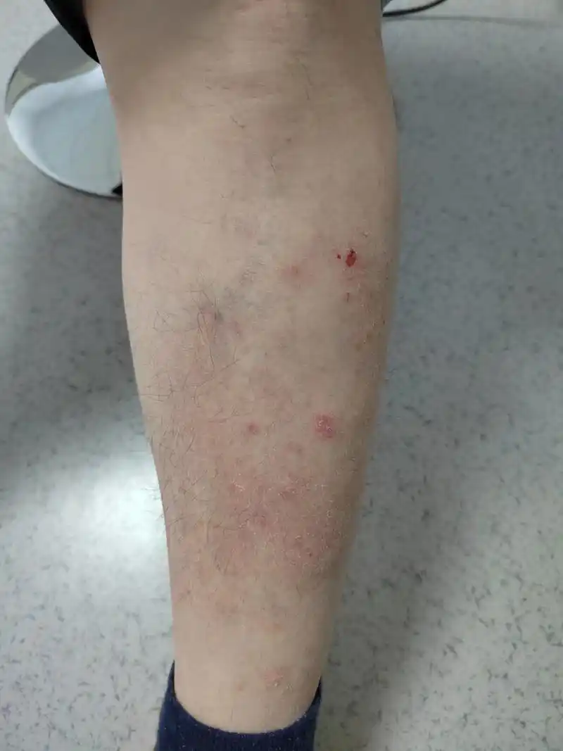 小腿部位的特应性皮炎症状使用生物制剂治疗后皮炎症状消退很快#解决