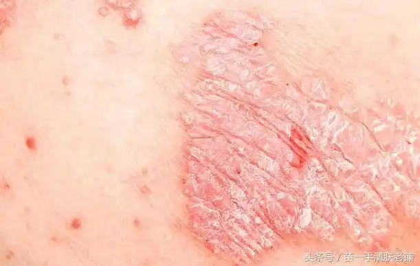 乏脂性皮炎即将来袭从四方面了解此病