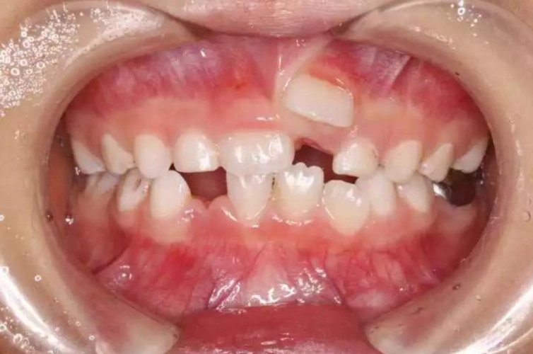 换牙时就有可能出现这种双排牙,这其实在今天并不少见,双排牙在医学上