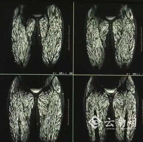 女子全身长满寄生虫 自幼逢年过节吃生猪肉