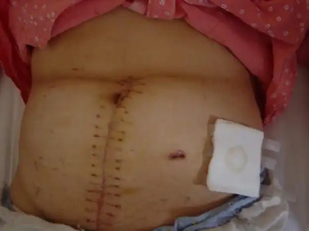 直肠癌传统开腹手术切口传统开腹手术与腔镜辅助手术切口对比省二院普