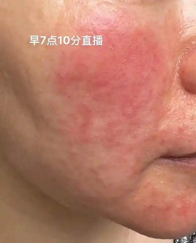 问题性皮肤管理 #玫瑰痤疮 #激素脸 #敏感肌 不断升级修 - 抖音